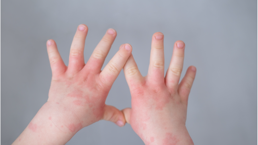 Bebeklerde ve çocuklarda besin alerjileri arttı