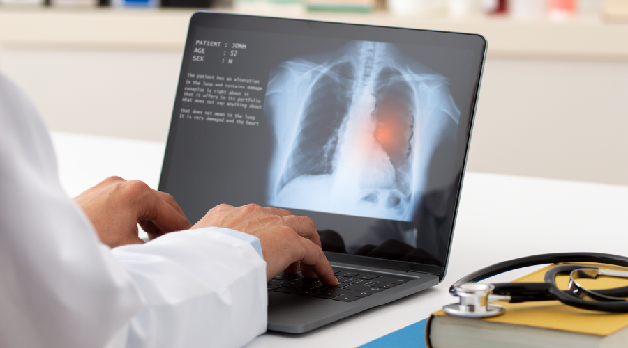 Bir yılda 25 bin kişi akciğer kanseri nedeniyle hayatını kaybetti